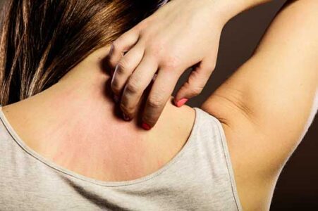 Natural Treatment of Allergic Dermatitis Image